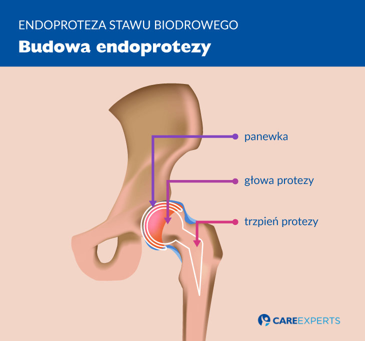 endoproteza stawu biodrowego - budowa endoprotezy