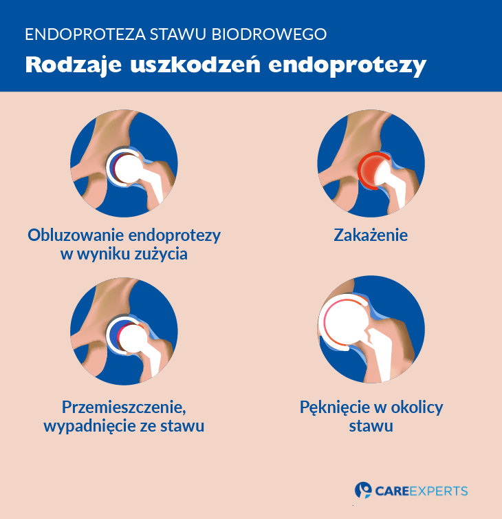 endoproteza stawu biodrowego - uszkodzenia