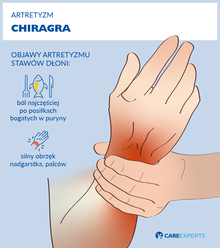 artretyzm objawy - chiragra