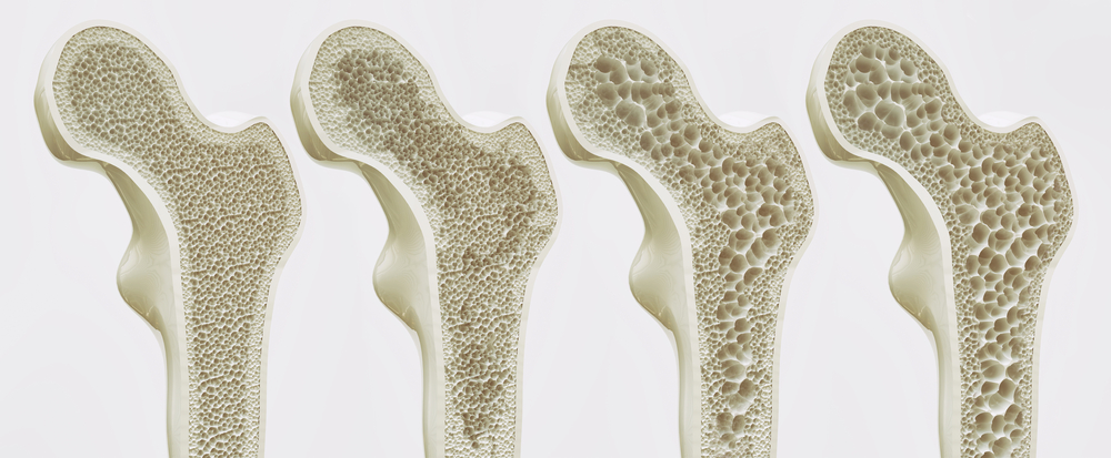 Osteoporoza - choroba kości